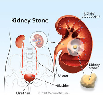 Kidney Stone treatment in Delhi