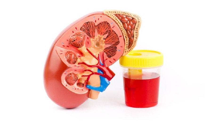 hematuria